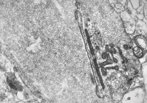 F,15y. | infantile neuroaxonal dystrophy (Seitelberger) F,15y. | infantile neuroaxonal dystrophy (Seitelberger)